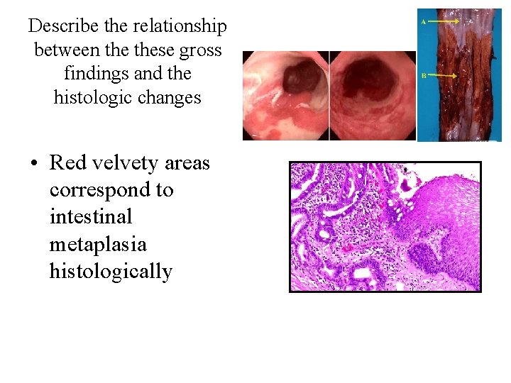 Describe the relationship between these gross findings and the histologic changes • Red velvety