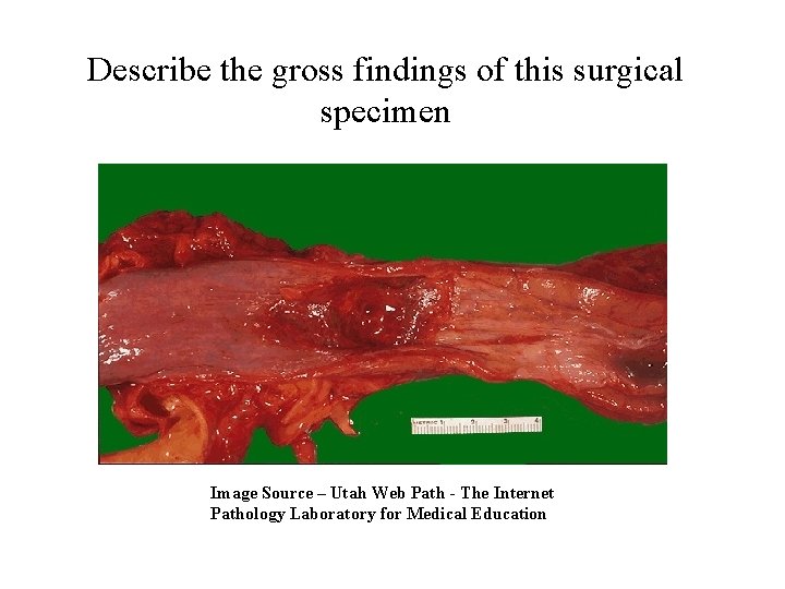 Describe the gross findings of this surgical specimen Image Source – Utah Web Path