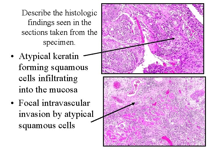 Describe the histologic findings seen in the sections taken from the specimen. • Atypical