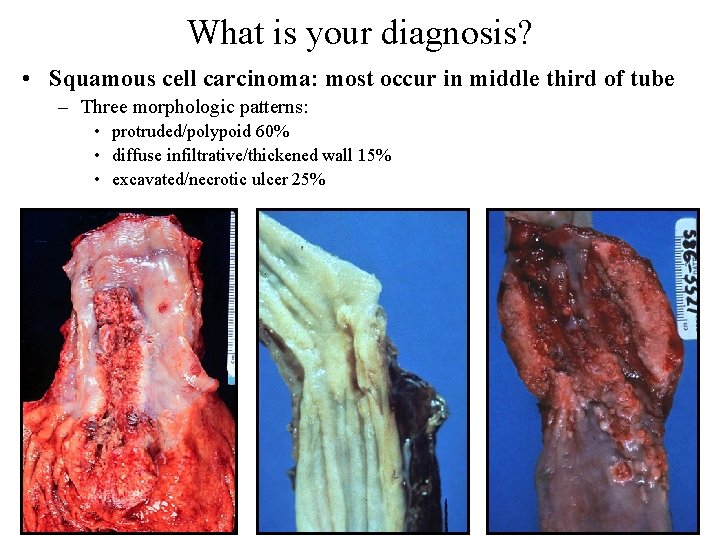 What is your diagnosis? • Squamous cell carcinoma: most occur in middle third of