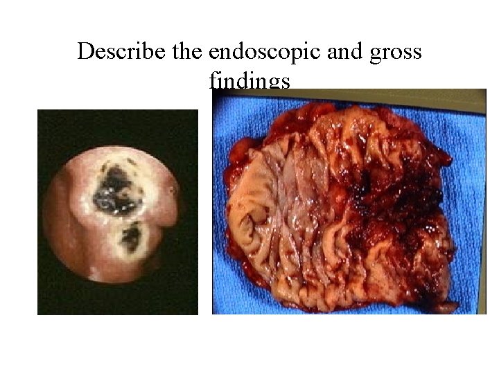 Describe the endoscopic and gross findings 