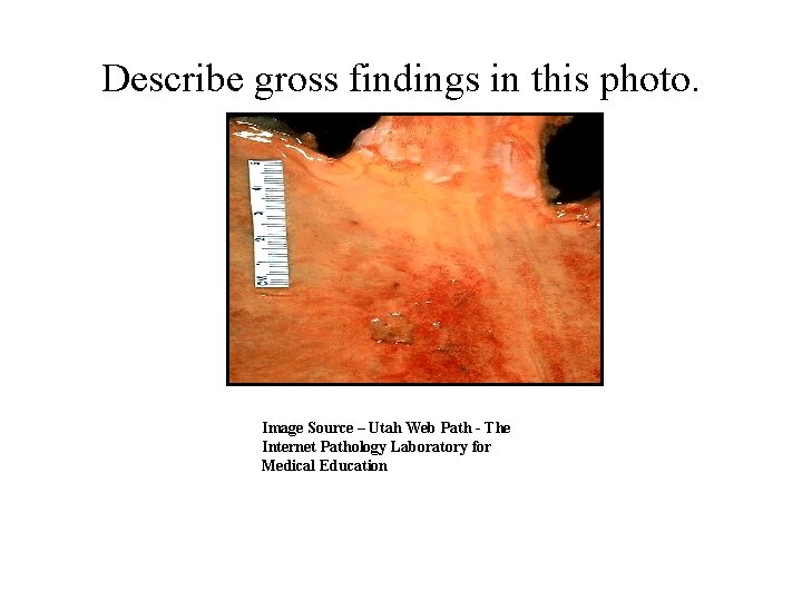 Describe gross findings in this photo. Image Source – Utah Web Path - The
