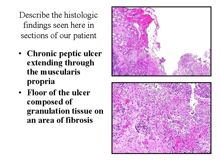 Describe the histologic findings seen here in sections of our patient • Chronic peptic