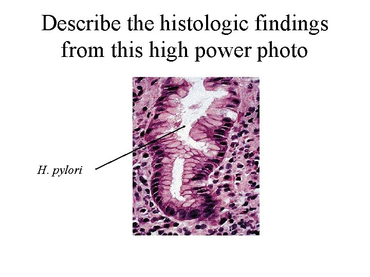 Describe the histologic findings from this high power photo H. pylori 