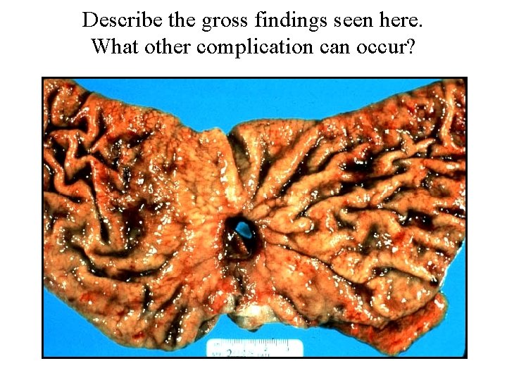 Describe the gross findings seen here. What other complication can occur? 