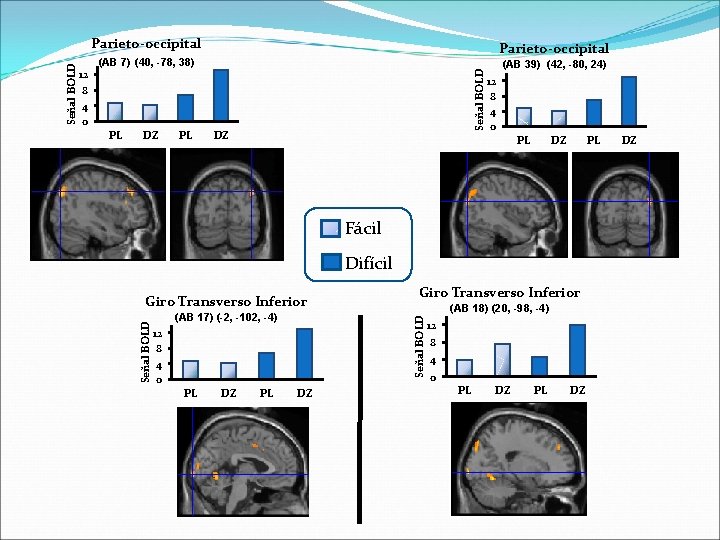Parieto-occipital (AB 7) (40, -78, 38) DZ PL DZ (AB 39) (42, -80, 24)