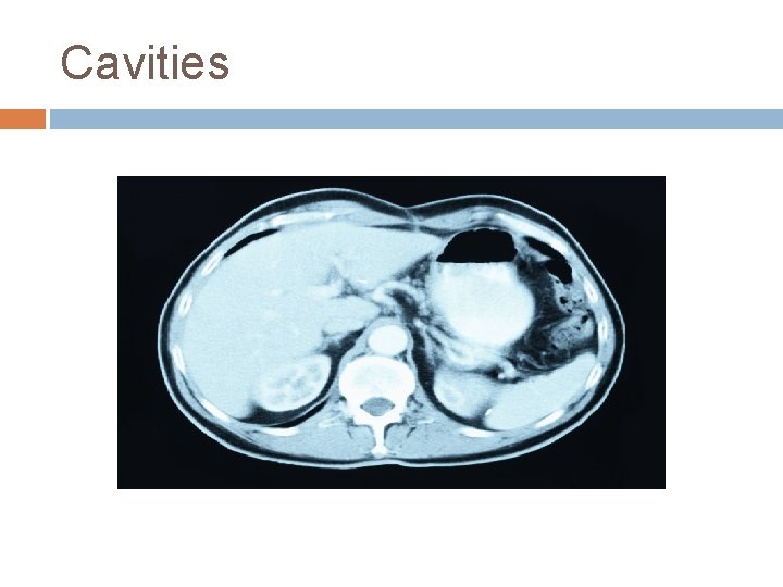 Cavities 