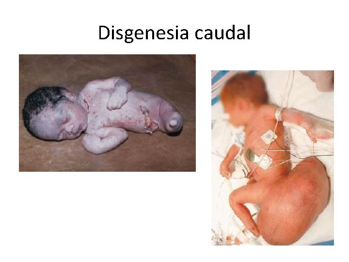 Disgenesia caudal 