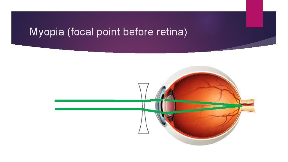 Myopia (focal point before retina) 