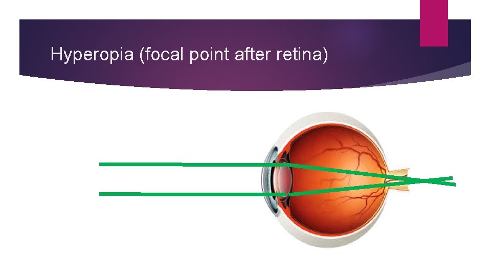Hyperopia (focal point after retina) 