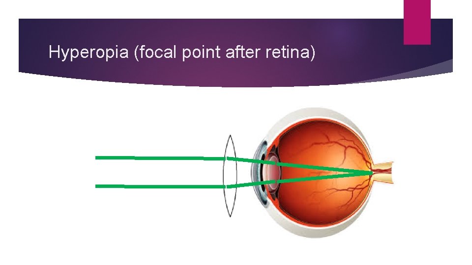 Hyperopia (focal point after retina) 