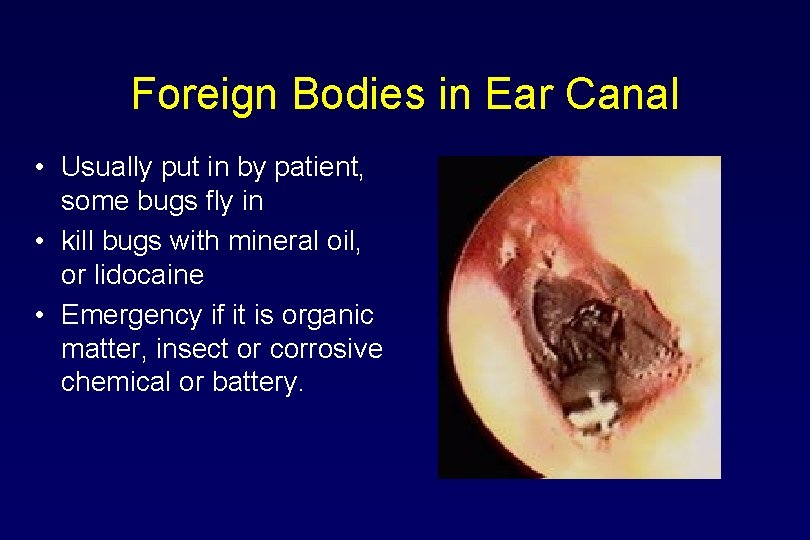 Foreign Bodies in Ear Canal • Usually put in by patient, some bugs fly