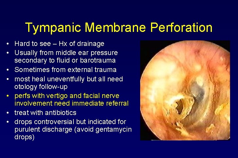 Tympanic Membrane Perforation • Hard to see – Hx of drainage • Usually from