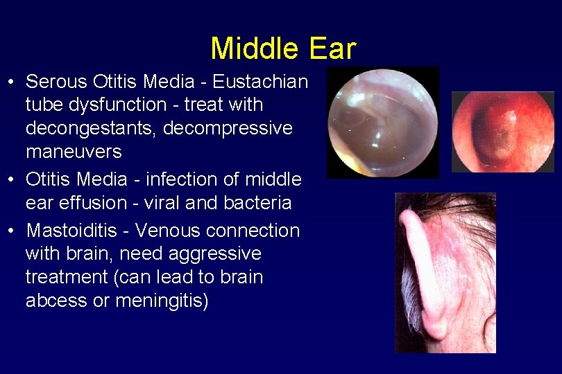 Middle Ear • Serous Otitis Media - Eustachian tube dysfunction - treat with decongestants,
