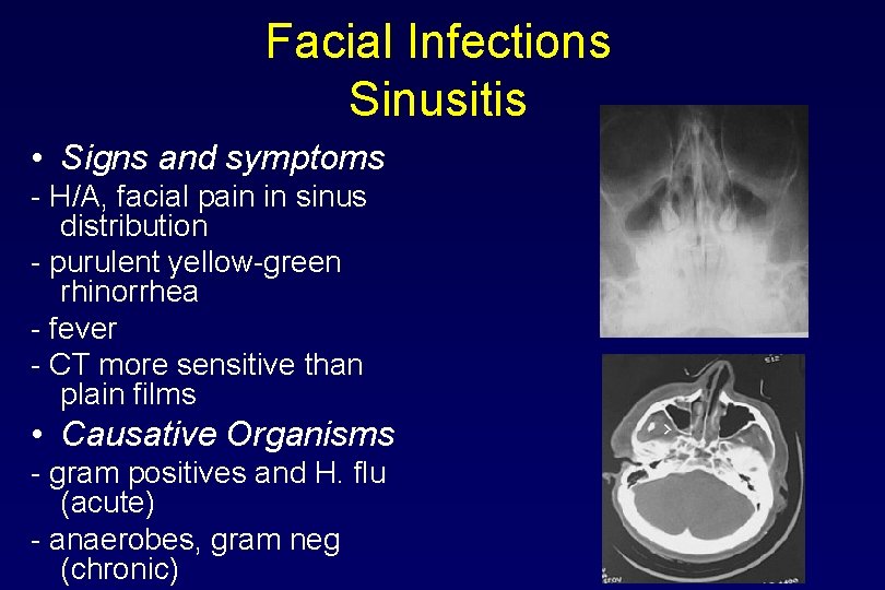 Facial Infections Sinusitis • Signs and symptoms - H/A, facial pain in sinus distribution