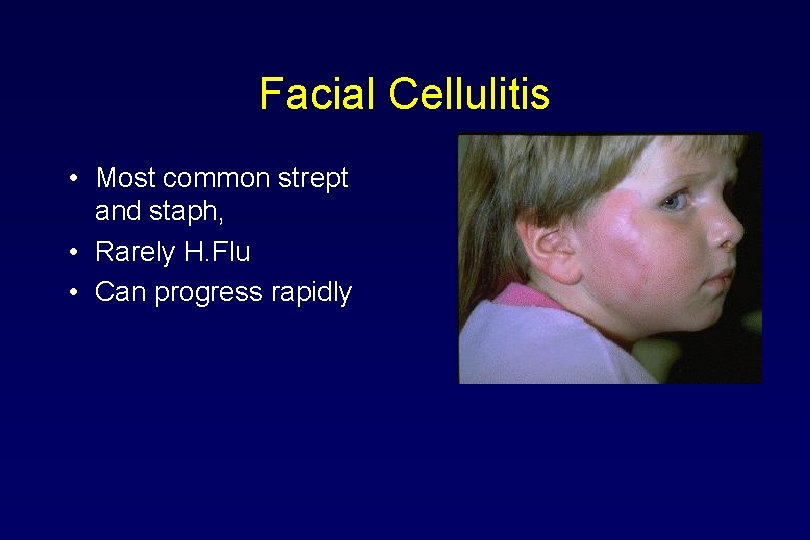 Facial Cellulitis • Most common strept and staph, • Rarely H. Flu • Can