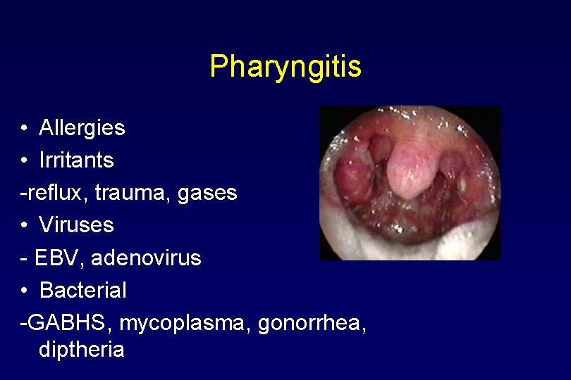Pharyngitis • Allergies • Irritants -reflux, trauma, gases • Viruses - EBV, adenovirus •