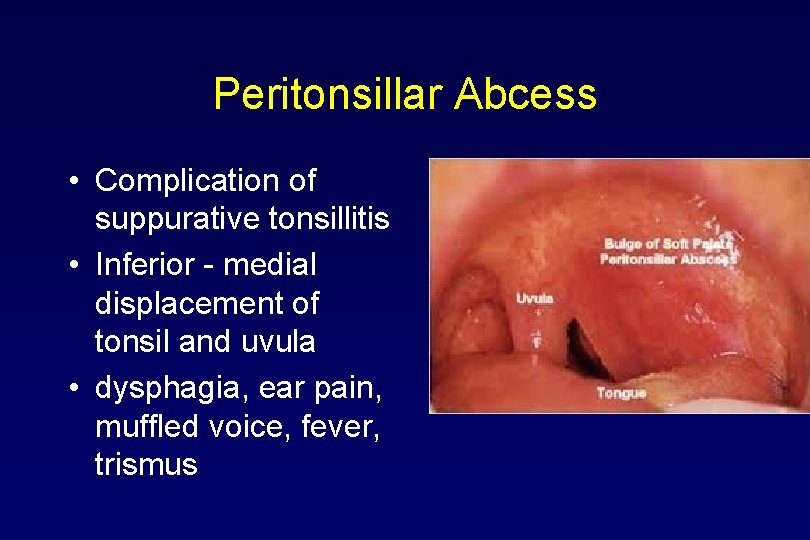 Peritonsillar Abcess • Complication of suppurative tonsillitis • Inferior - medial displacement of tonsil