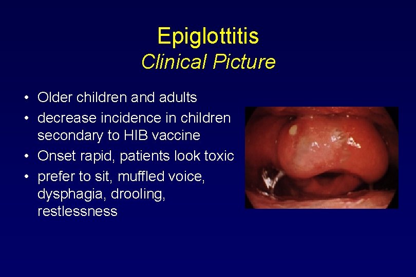 Epiglottitis Clinical Picture • Older children and adults • decrease incidence in children secondary
