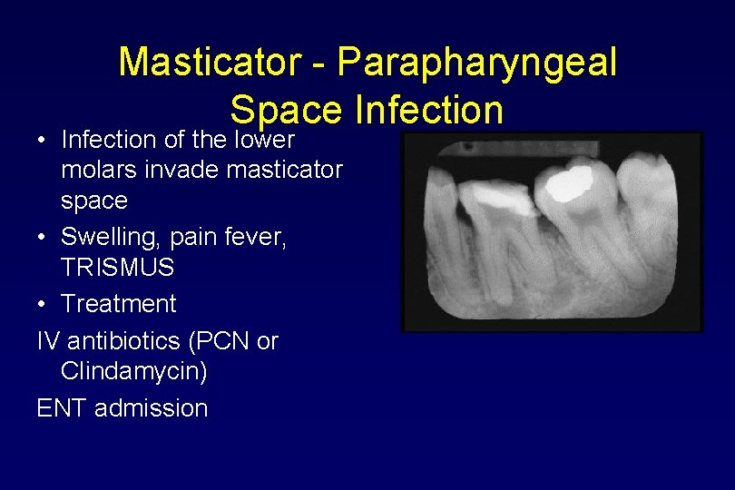 Masticator - Parapharyngeal Space Infection • Infection of the lower molars invade masticator space