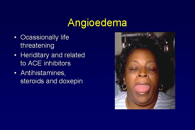 Angioedema • Ocassionally life threatening • Heriditary and related to ACE inhibitors • Antihistamines,