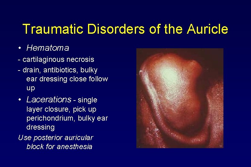 Traumatic Disorders of the Auricle • Hematoma - cartilaginous necrosis - drain, antibiotics, bulky