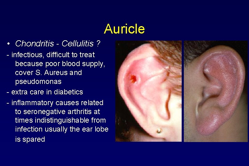 Auricle • Chondritis - Cellulitis ? - infectious, difficult to treat because poor blood