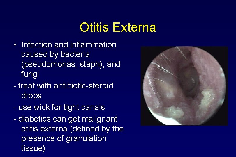 Otitis Externa • Infection and inflammation caused by bacteria (pseudomonas, staph), and fungi -