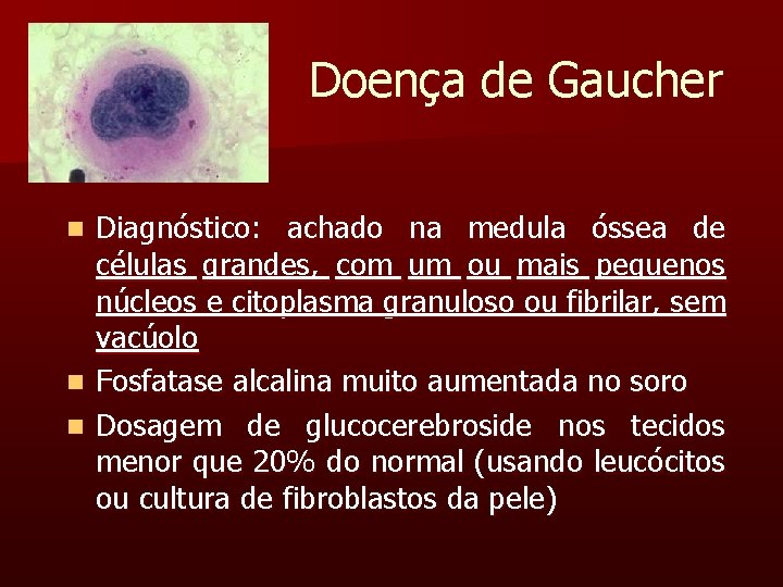 Doença de Gaucher Diagnóstico: achado na medula óssea de células grandes, com um ou