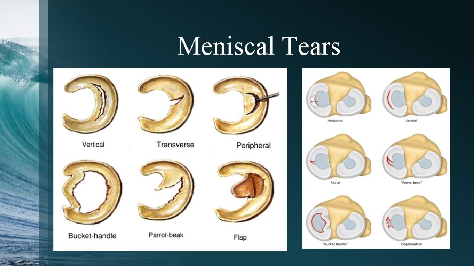 Meniscal Tears 