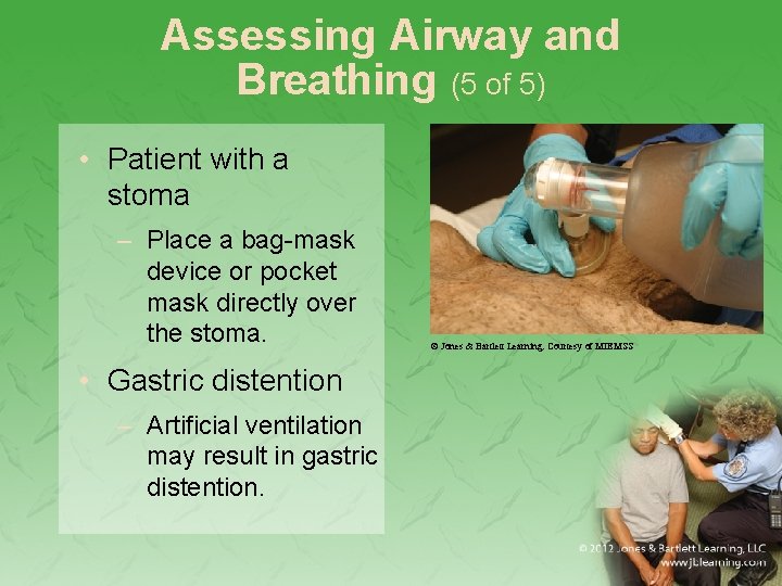 Assessing Airway and Breathing (5 of 5) • Patient with a stoma – Place
