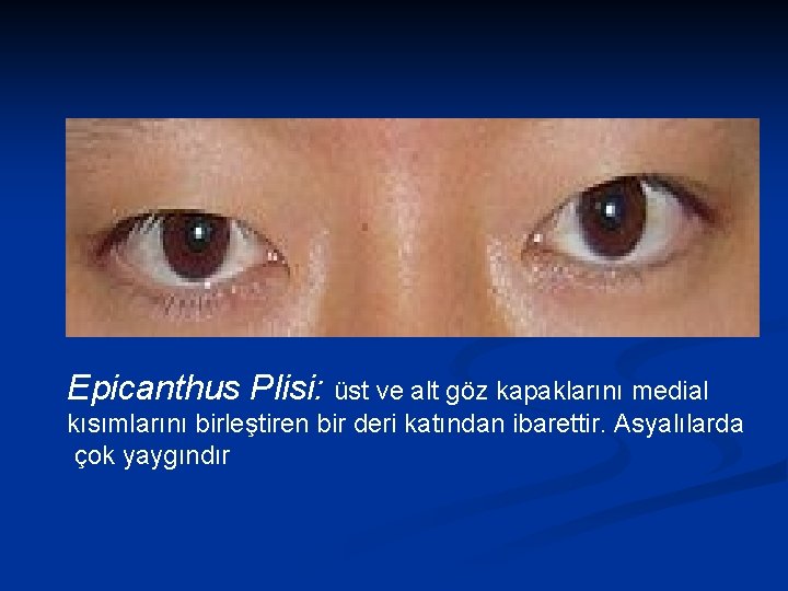 Epicanthus Plisi: üst ve alt göz kapaklarını medial kısımlarını birleştiren bir deri katından ibarettir.