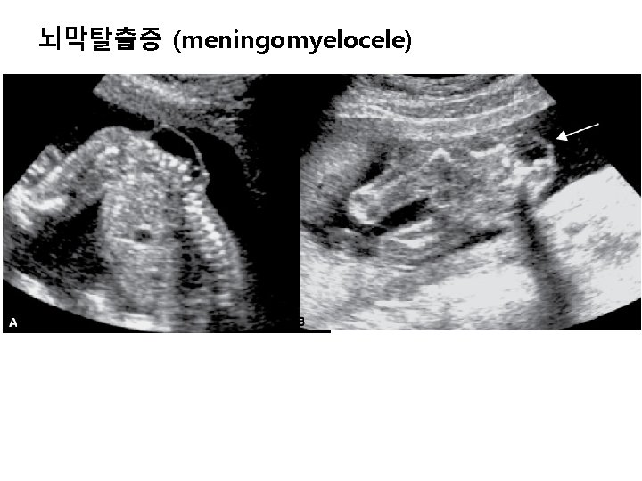 뇌막탈출증 (meningomyelocele) 