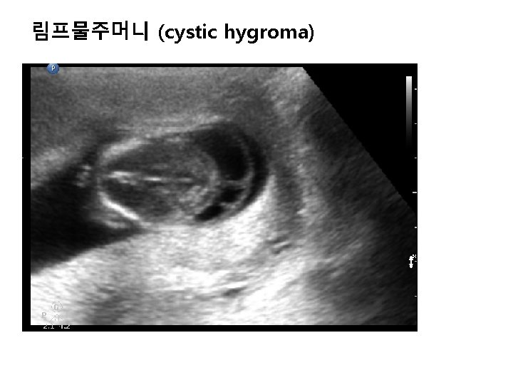 림프물주머니 (cystic hygroma) 