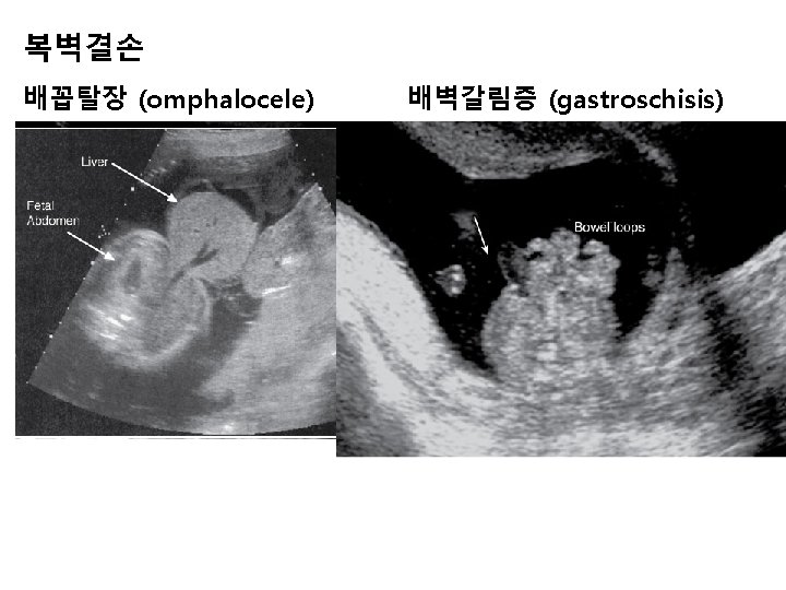 복벽결손 배꼽탈장 (omphalocele) 배벽갈림증 (gastroschisis) 