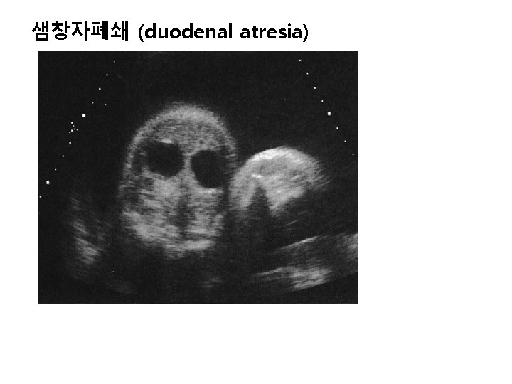 샘창자폐쇄 (duodenal atresia) 