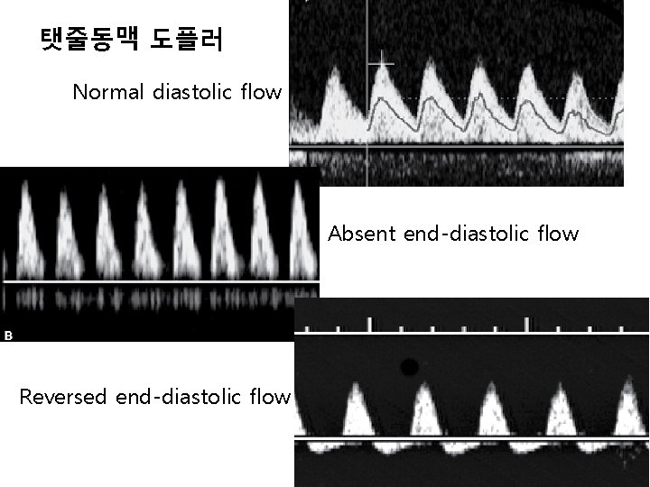 탯줄동맥 도플러 Normal diastolic flow Absent end-diastolic flow Reversed end-diastolic flow 