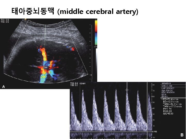 태아중뇌동맥 (middle cerebral artery) 