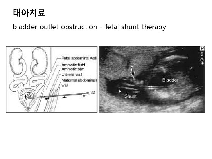 태아치료 bladder outlet obstruction - fetal shunt therapy 