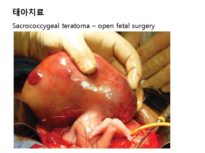 태아치료 Sacrococcygeal teratoma – open fetal surgery 