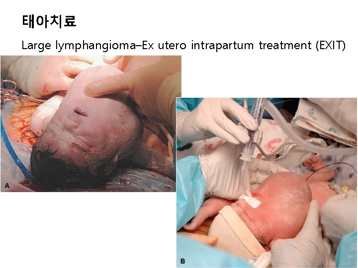 태아치료 Large lymphangioma–Ex utero intrapartum treatment (EXIT) 