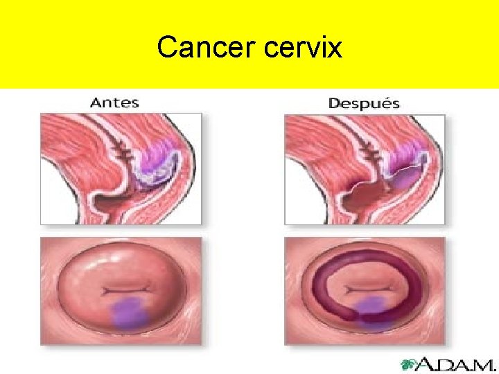Cancer cervix 