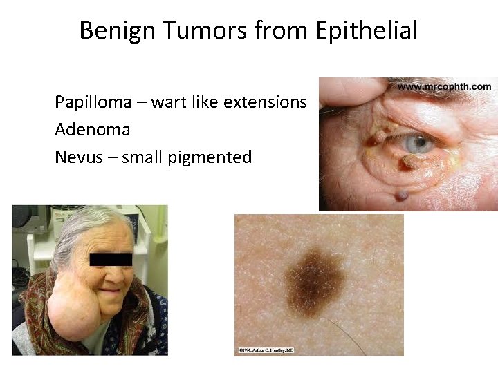 Benign Tumors from Epithelial Papilloma – wart like extensions Adenoma Nevus – small pigmented