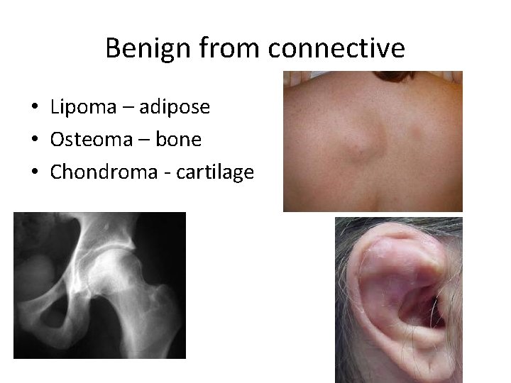 Benign from connective • Lipoma – adipose • Osteoma – bone • Chondroma -