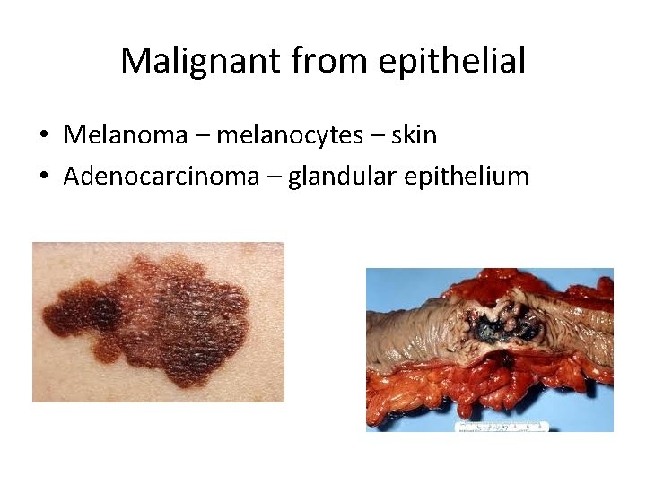 Malignant from epithelial • Melanoma – melanocytes – skin • Adenocarcinoma – glandular epithelium