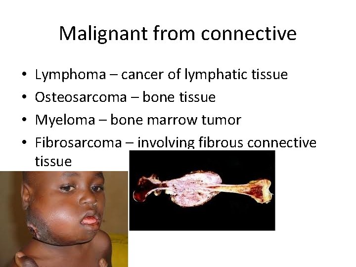 Malignant from connective • • Lymphoma – cancer of lymphatic tissue Osteosarcoma – bone