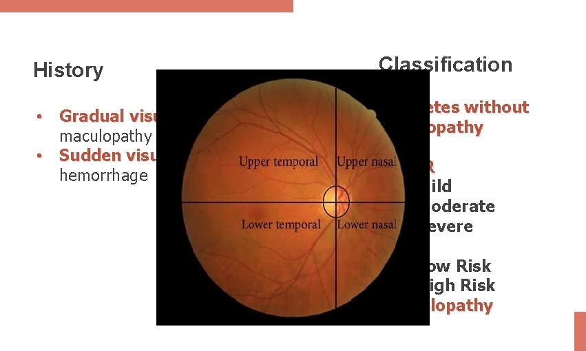 History • Gradual visual loss: in maculopathy • Sudden visual loss: in vitreous hemorrhage
