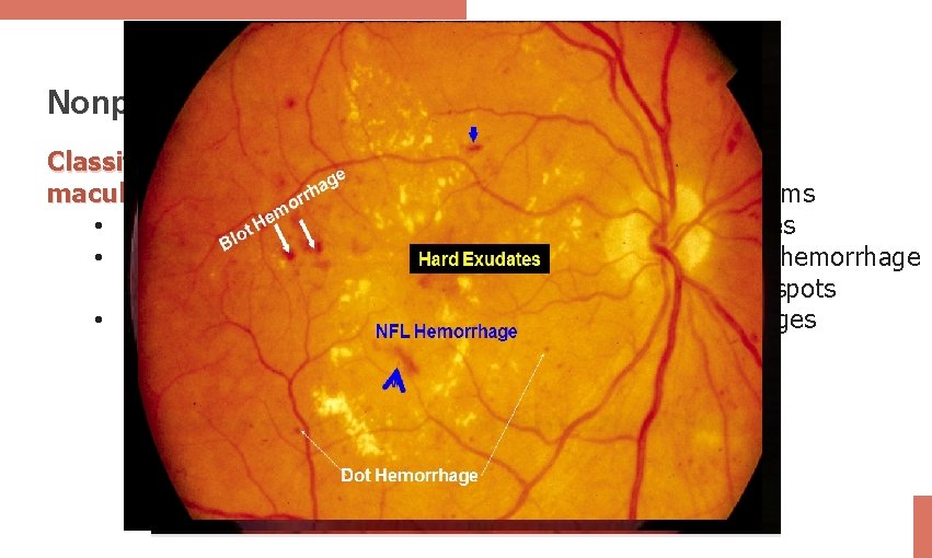 Nonproliferative Retinopathy Classification (with or without maculopathy): • Mild: MAs only • Moderate: MA