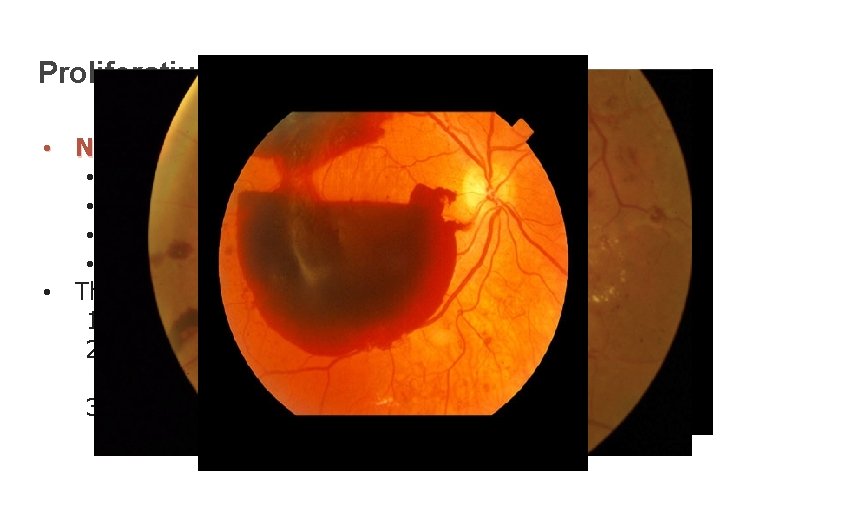 Proliferative Retinopathy • Neovascularization in: • Disc (NVD) • Elsewhere (NVE) • Iris (NVI)