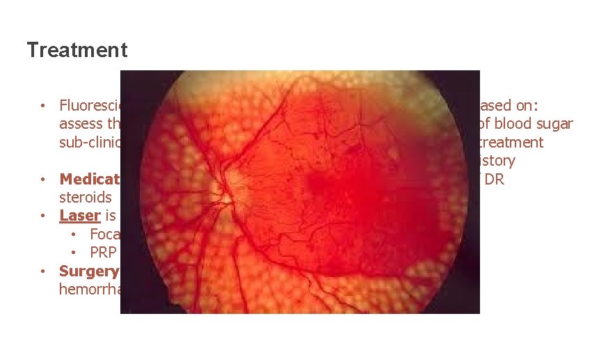 Treatment • Fluorescien angigraphy could be used to assess the degree of ischemia, edema